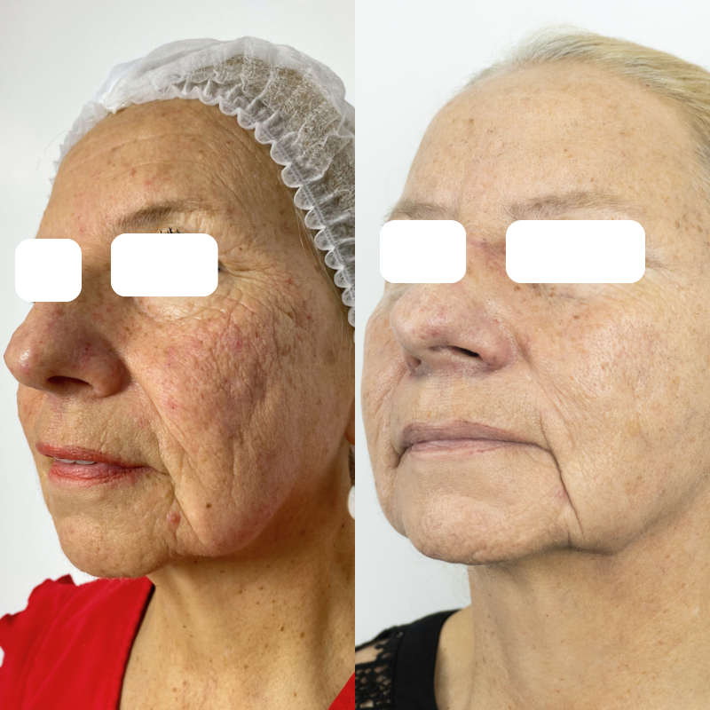 Antes y después renovación facial